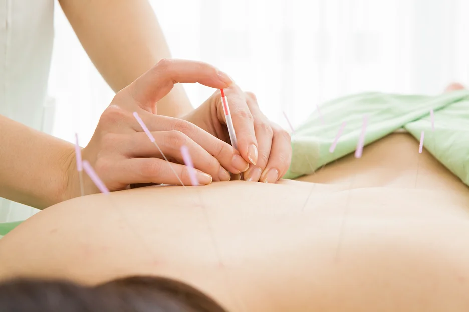 acupuncture for back pain